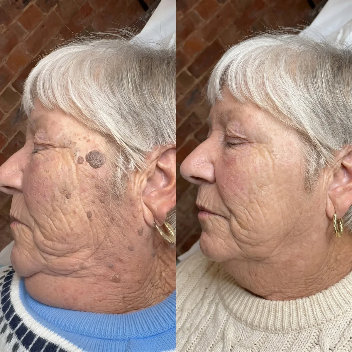 Reference campaign before and after appearance photo on mature skin; individual results vary