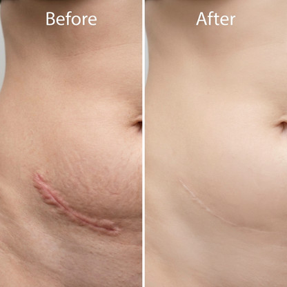 Source-provided scar appearance comparison on the abdomen