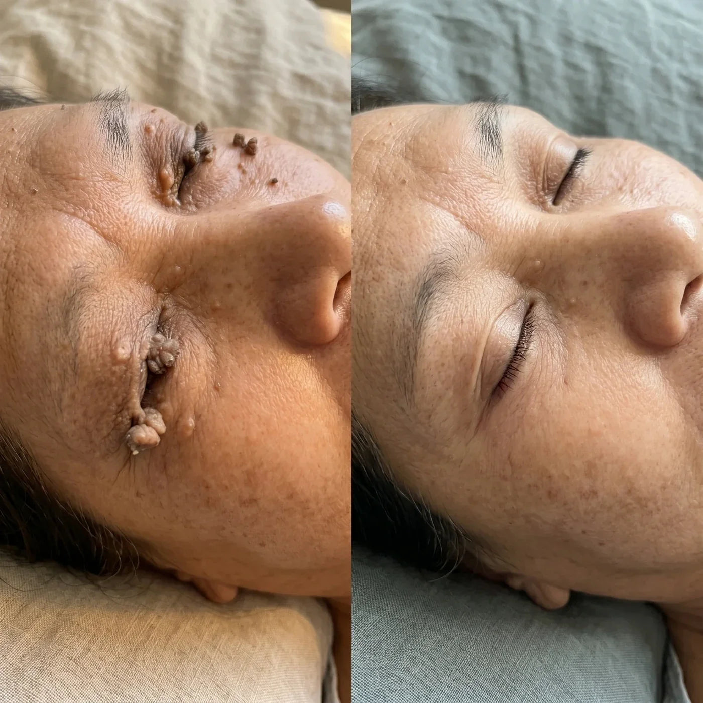 Reference campaign before and after appearance photo across deeper skin tone; individual results vary