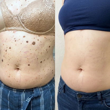 Reference campaign before and after torso appearance photo; individual results vary