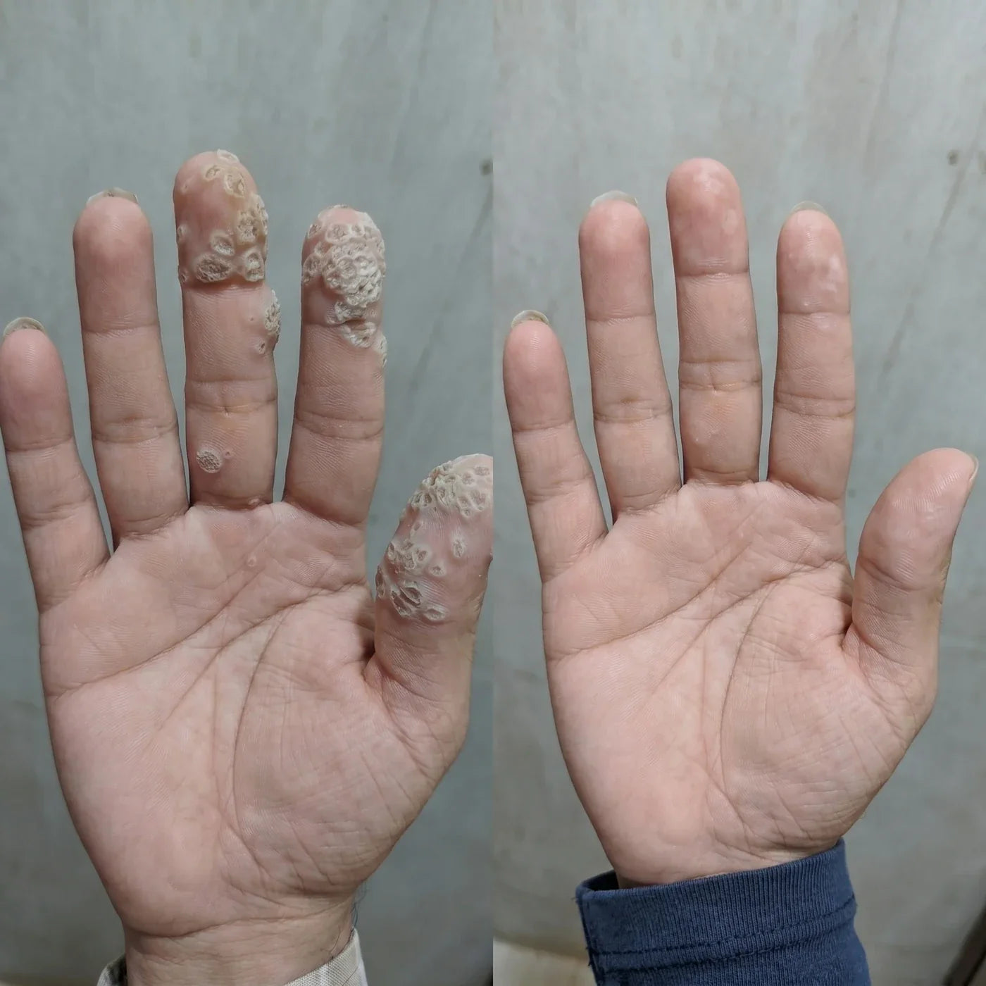 Reference campaign before and after hand appearance photo; individual results vary
