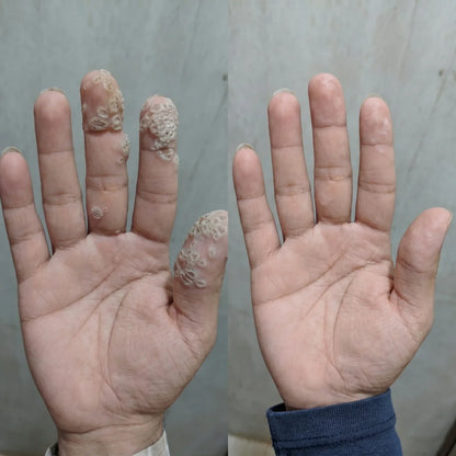 Reference campaign before and after hand appearance photo; individual results vary